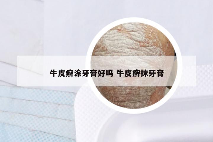牛皮癣涂牙膏好吗 牛皮癣抹牙膏