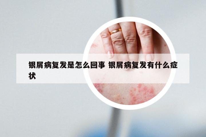 银屑病复发是怎么回事 银屑病复发有什么症状