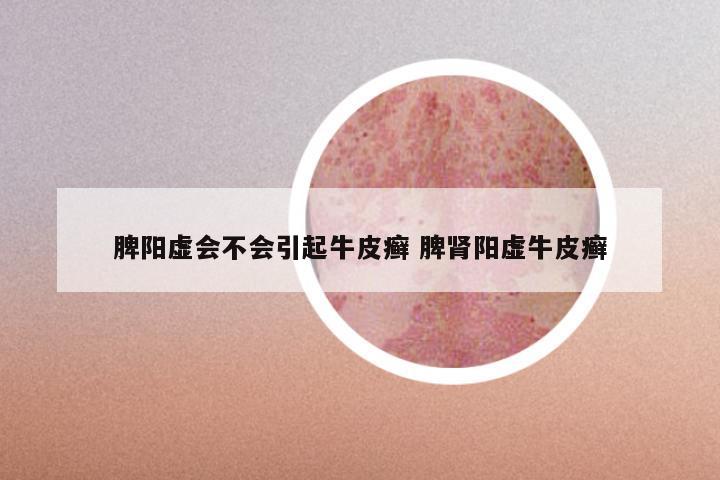 脾阳虚会不会引起牛皮癣 脾肾阳虚牛皮癣