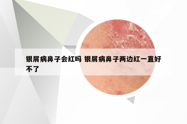 银屑病鼻子会红吗 银屑病鼻子两边红一直好不了