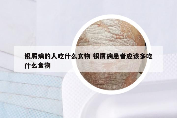 银屑病的人吃什么食物 银屑病患者应该多吃什么食物