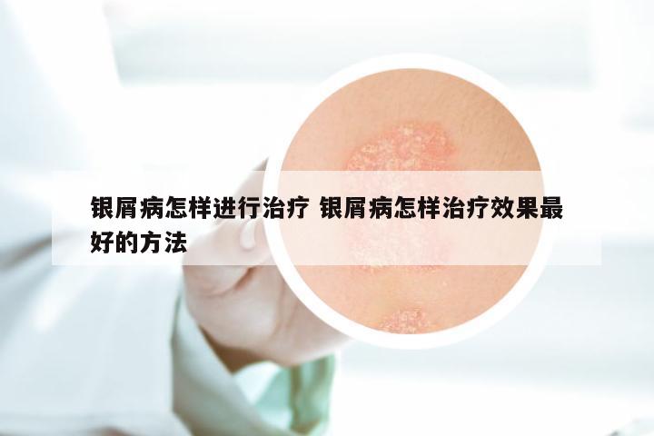 银屑病怎样进行治疗 银屑病怎样治疗效果最好的方法
