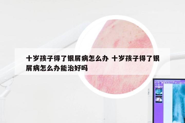 十岁孩子得了银屑病怎么办 十岁孩子得了银屑病怎么办能治好吗
