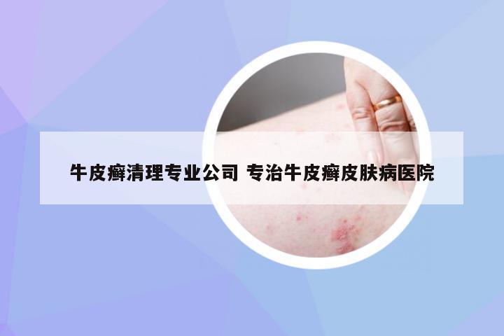 牛皮癣清理专业公司 专治牛皮癣皮肤病医院