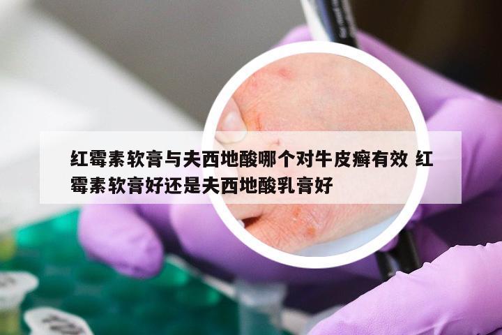 红霉素软膏与夫西地酸哪个对牛皮癣有效 红霉素软膏好还是夫西地酸乳膏好
