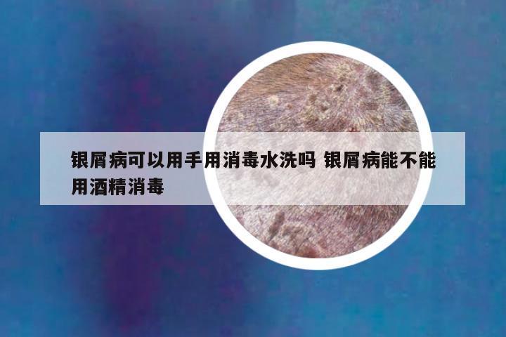 银屑病可以用手用消毒水洗吗 银屑病能不能用酒精消毒