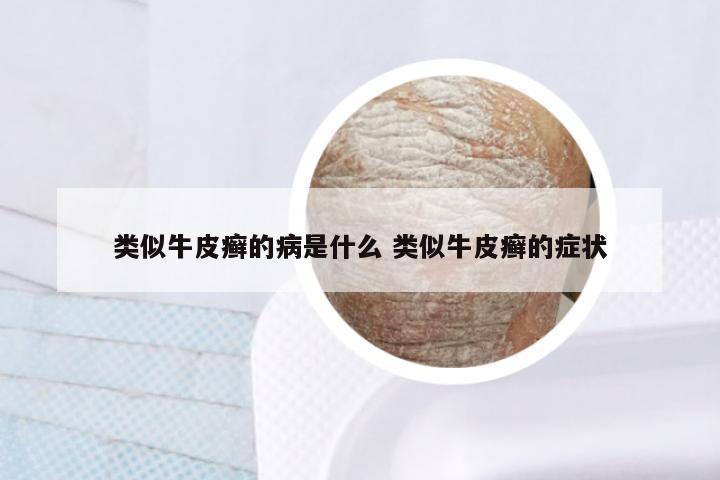 类似牛皮癣的病是什么 类似牛皮癣的症状