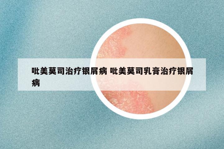 吡美莫司治疗银屑病 吡美莫司乳膏治疗银屑病
