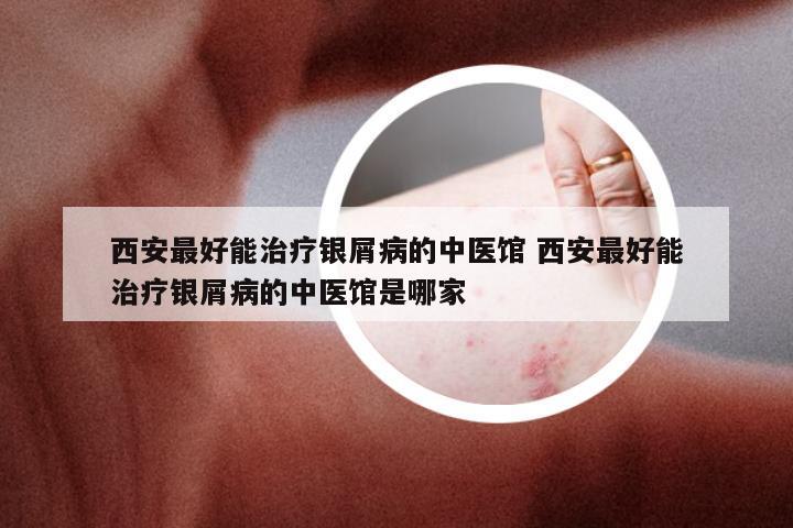 西安最好能治疗银屑病的中医馆 西安最好能治疗银屑病的中医馆是哪家