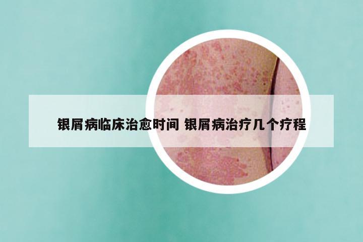 银屑病临床治愈时间 银屑病治疗几个疗程
