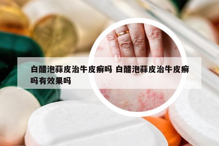 白醋泡蒜皮治牛皮癣吗 白醋泡蒜皮治牛皮癣吗有效果吗