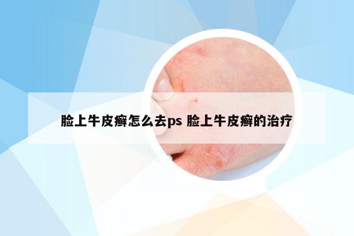 脸上牛皮癣怎么去ps 脸上牛皮癣的治疗