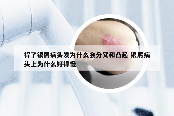 得了银屑病头发为什么会分叉和凸起 银屑病头上为什么好得慢
