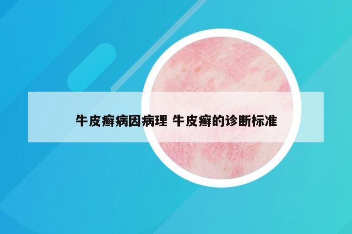 牛皮癣病因病理 牛皮癣的诊断标准