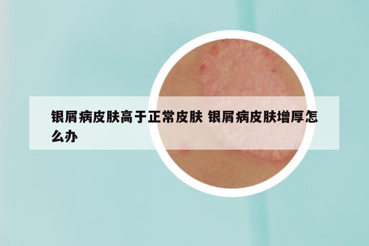 银屑病皮肤高于正常皮肤 银屑病皮肤增厚怎么办