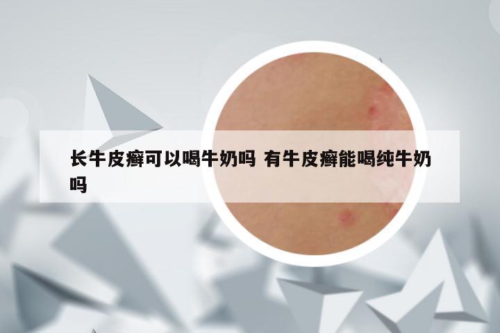长牛皮癣可以喝牛奶吗 有牛皮癣能喝纯牛奶吗