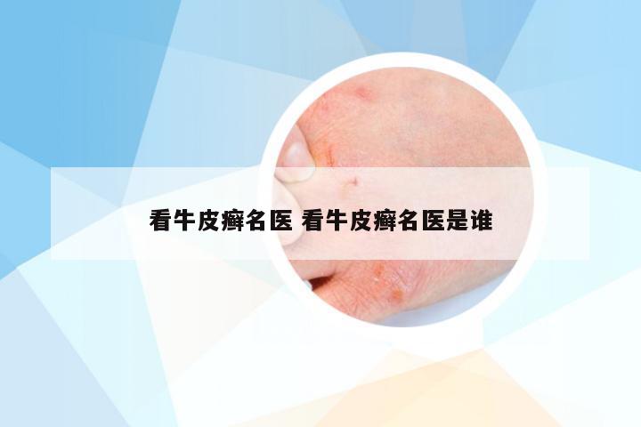 看牛皮癣名医 看牛皮癣名医是谁