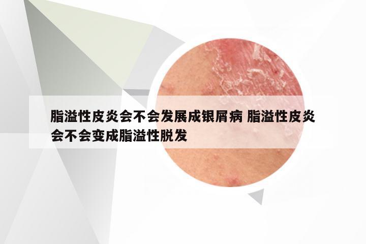 脂溢性皮炎会不会发展成银屑病 脂溢性皮炎会不会变成脂溢性脱发