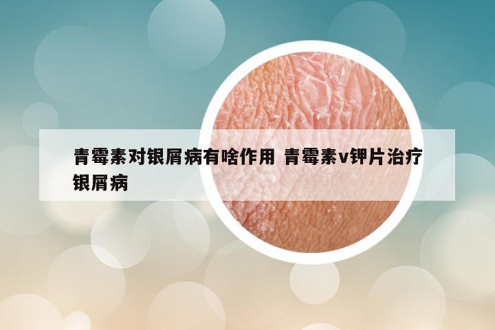 青霉素对银屑病有啥作用 青霉素v钾片治疗银屑病