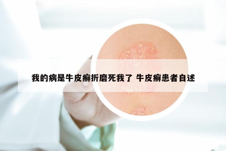 我的病是牛皮癣折磨死我了 牛皮癣患者自述