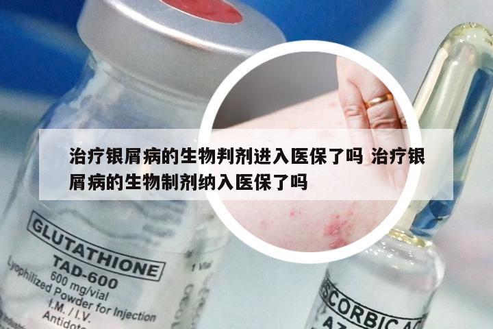治疗银屑病的生物判剂进入医保了吗 治疗银屑病的生物制剂纳入医保了吗