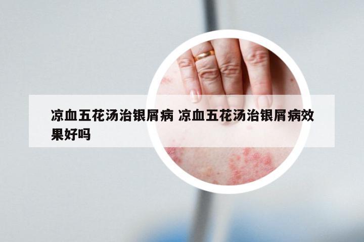 凉血五花汤治银屑病 凉血五花汤治银屑病效果好吗