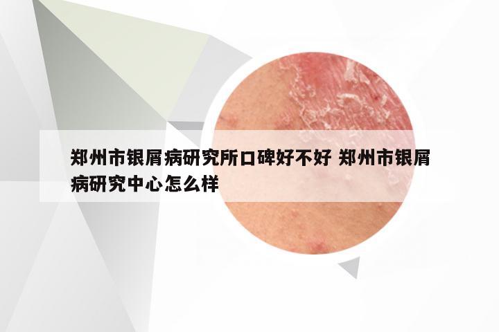 郑州市银屑病研究所口碑好不好 郑州市银屑病研究中心怎么样