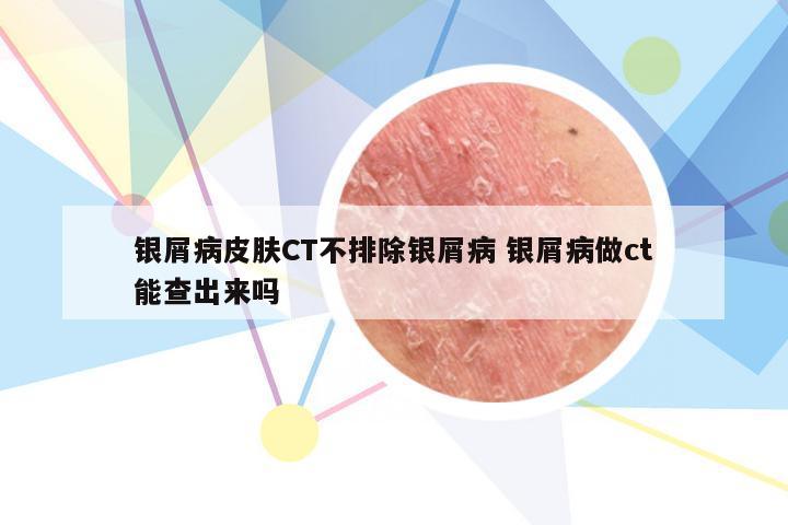 银屑病皮肤CT不排除银屑病 银屑病做ct能查出来吗