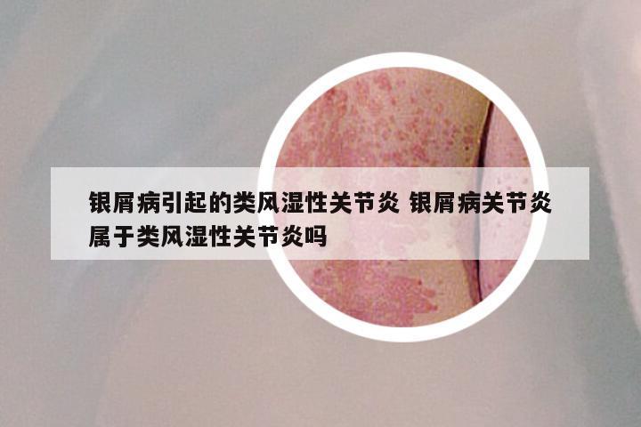 银屑病引起的类风湿性关节炎 银屑病关节炎属于类风湿性关节炎吗