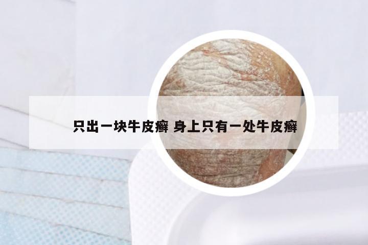 只出一块牛皮癣 身上只有一处牛皮癣
