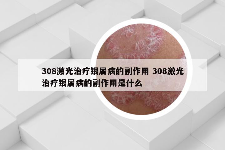 308激光治疗银屑病的副作用 308激光治疗银屑病的副作用是什么