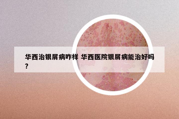 华西治银屑病咋样 华西医院银屑病能治好吗?