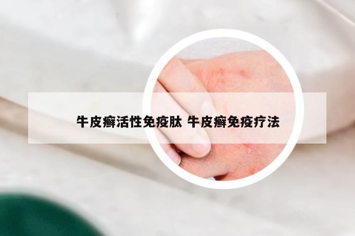 牛皮癣活性免疫肽 牛皮癣免疫疗法