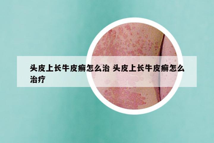 头皮上长牛皮癣怎么治 头皮上长牛皮癣怎么治疗