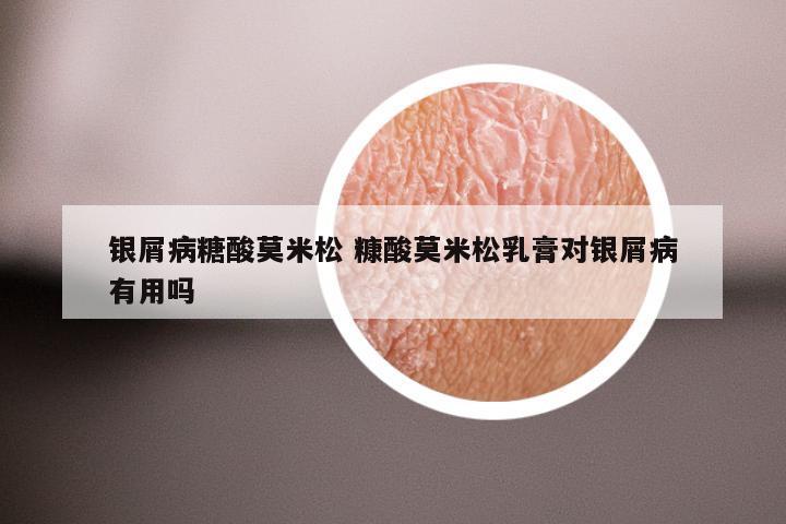 银屑病糖酸莫米松 糠酸莫米松乳膏对银屑病有用吗