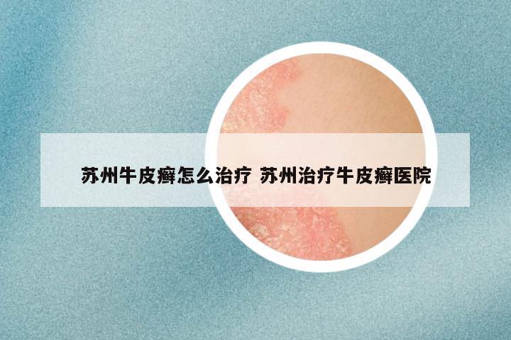 苏州牛皮癣怎么治疗 苏州治疗牛皮癣医院