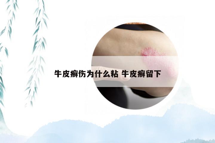 牛皮癣伤为什么粘 牛皮癣留下