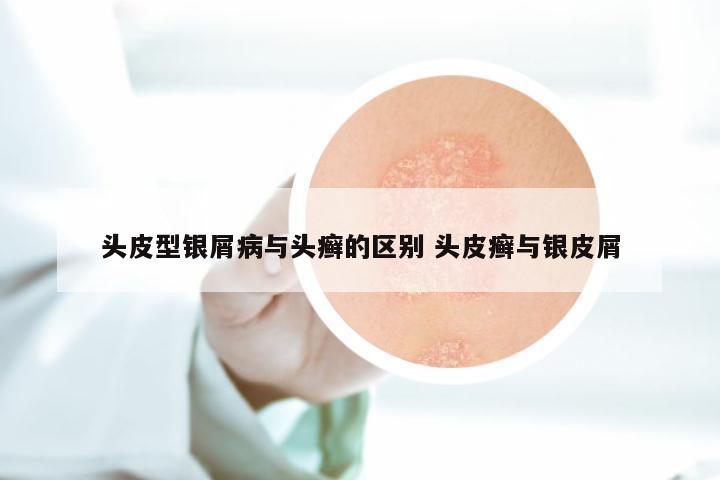 头皮型银屑病与头癣的区别 头皮癣与银皮屑