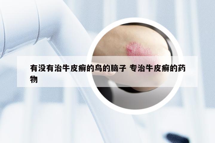 有没有治牛皮癣的鸟的脑子 专治牛皮癣的药物