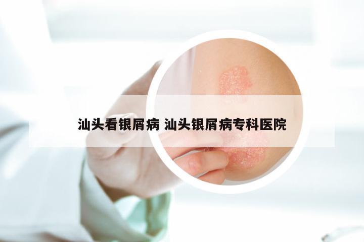 汕头看银屑病 汕头银屑病专科医院