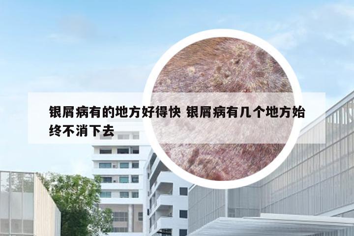 银屑病有的地方好得快 银屑病有几个地方始终不消下去