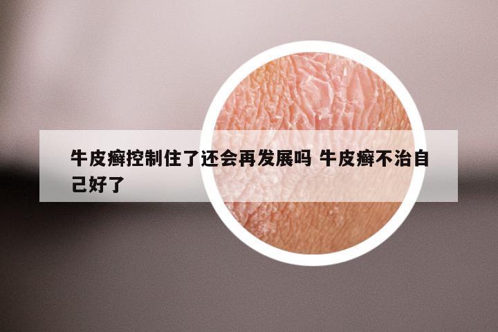 牛皮癣控制住了还会再发展吗 牛皮癣不治自己好了