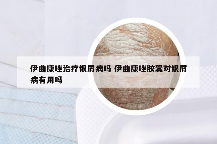 伊曲康唑治疗银屑病吗 伊曲康唑胶囊对银屑病有用吗