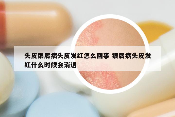 头皮银屑病头皮发红怎么回事 银屑病头皮发红什么时候会消退
