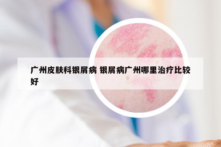 广州皮肤科银屑病 银屑病广州哪里治疗比较好