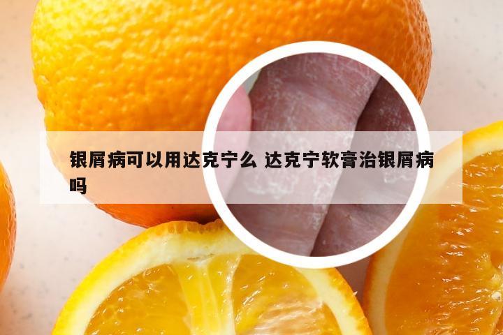 银屑病可以用达克宁么 达克宁软膏治银屑病吗