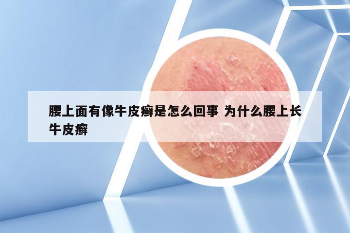 腰上面有像牛皮癣是怎么回事 为什么腰上长牛皮癣
