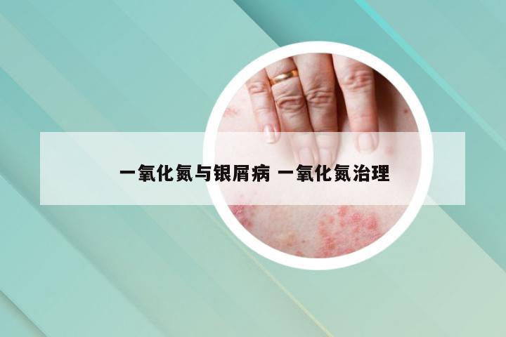 一氧化氮与银屑病 一氧化氮治理