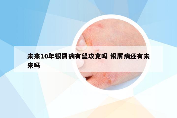 未来10年银屑病有望攻克吗 银屑病还有未来吗