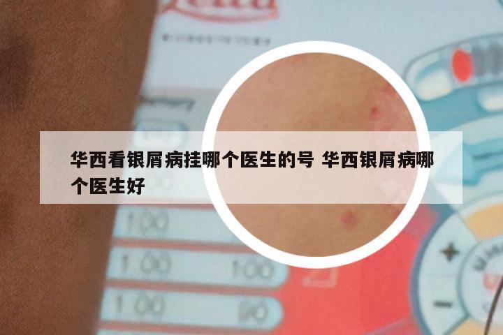 华西看银屑病挂哪个医生的号 华西银屑病哪个医生好